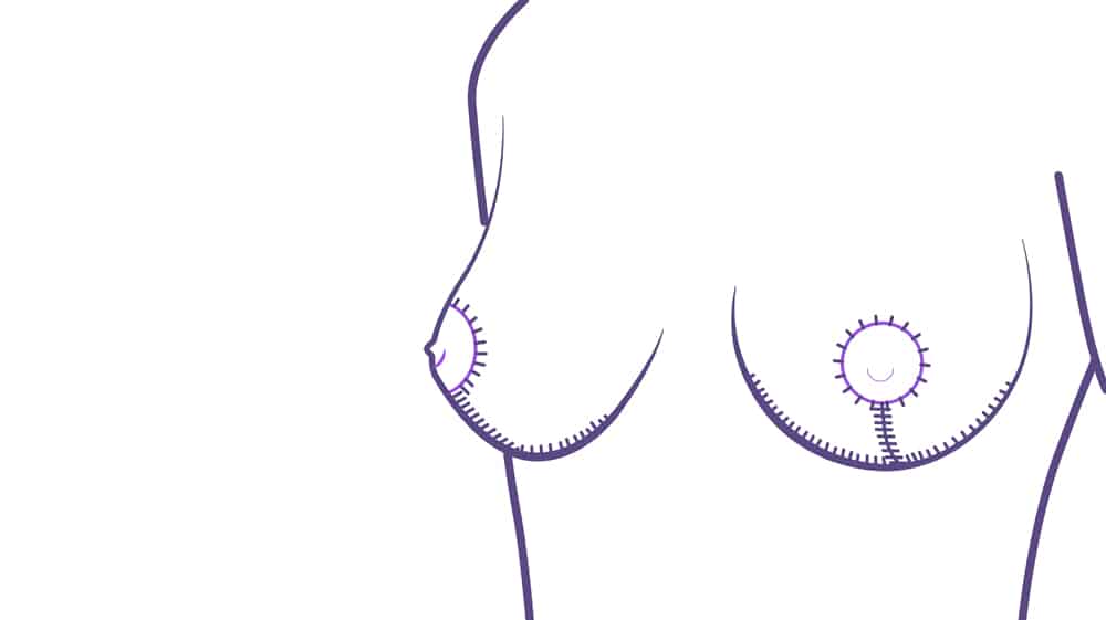 Cicatrices mastopexia