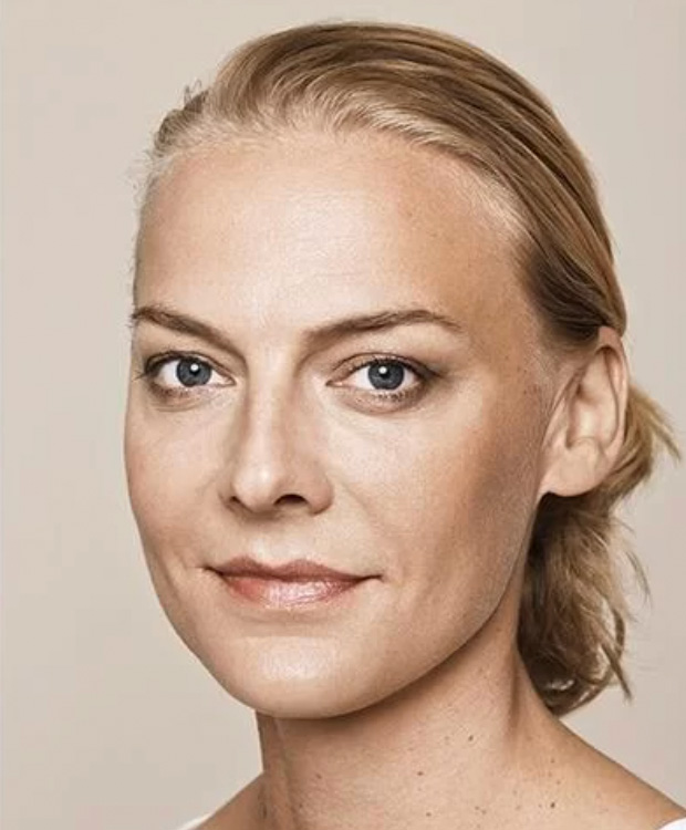 Skinbooster antes y después