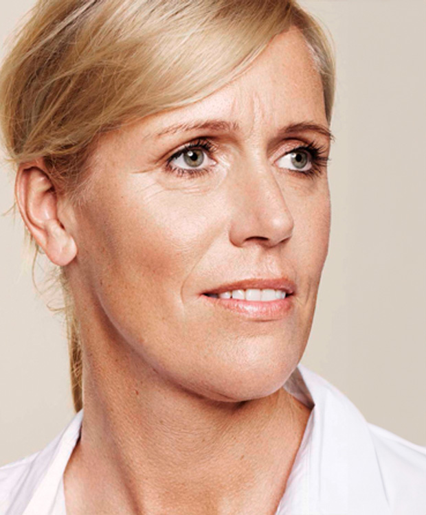 Skinbooster facial antes y después