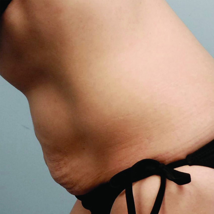 Bodytite abdomen antes y después