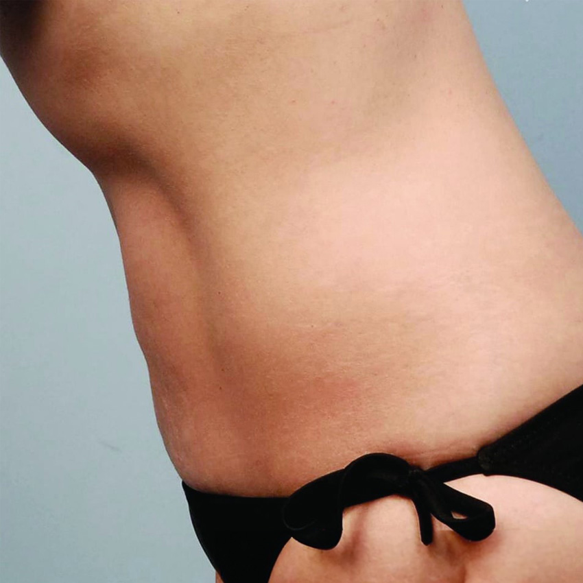 Bodytite abdomen antes y después