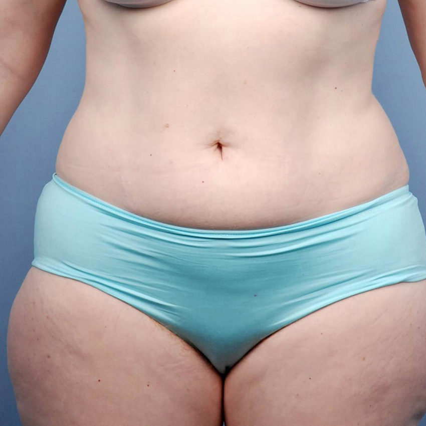 Bodytite antes y después