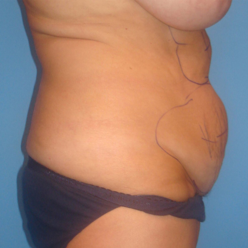 Bodytite resultados