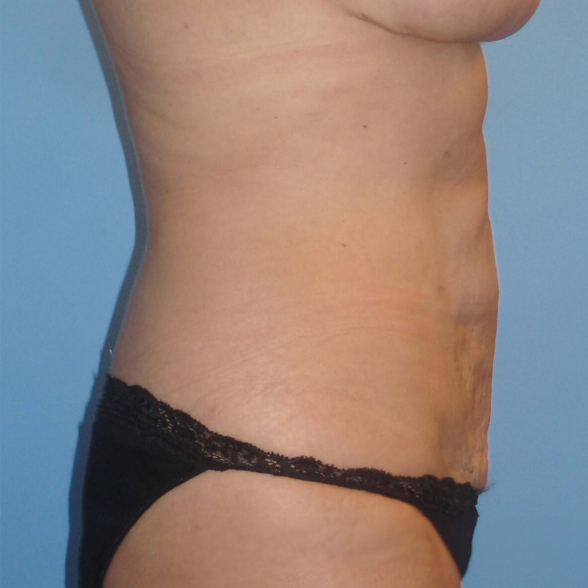 Bodytite resultados