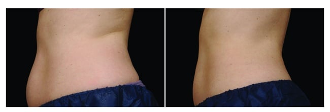 CoolSculpting antes y después - abdomen vista lateral