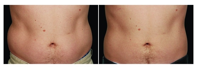 CoolSculpting antes y después - abdomen