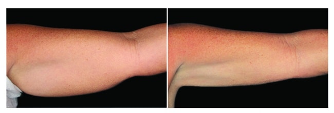 CoolSculpting antes y después - brazos mujer