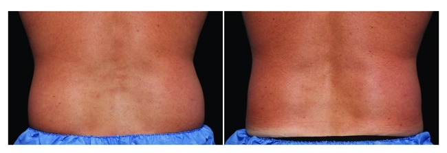 CoolSculpting antes y después - cadera