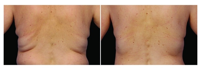 CoolSculpting antes y después - espalda hombre