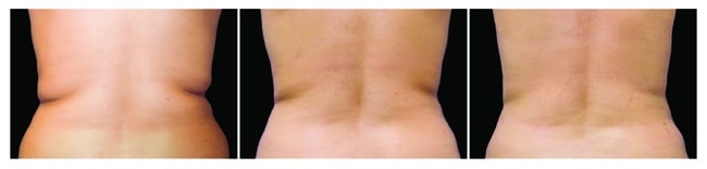 CoolSculpting antes y después - espalda hombre