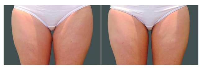 CoolSculpting muslos