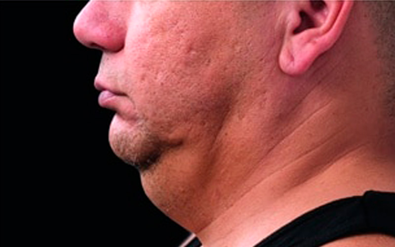 CoolSculpting papada antes - hombre