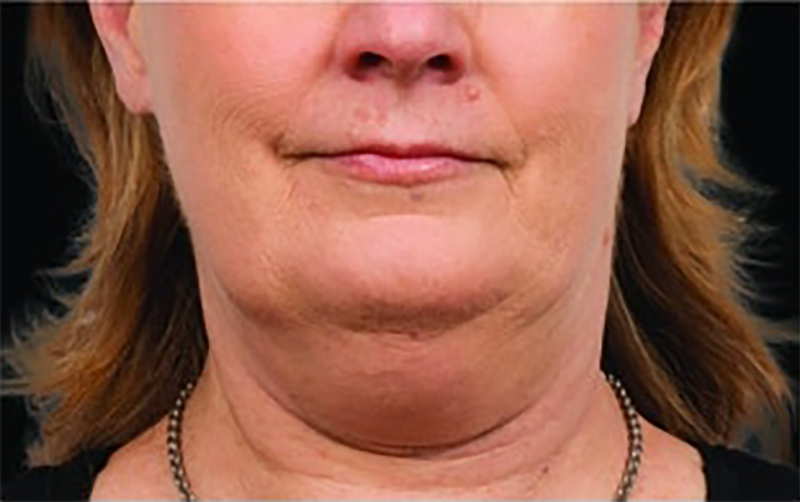 CoolSculpting papada antes - mujer