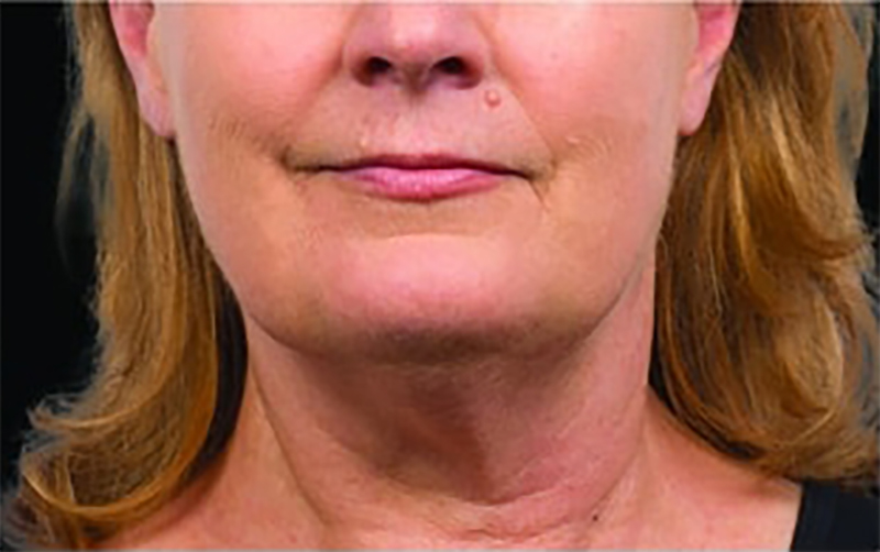 CoolSculpting papada después - mujer