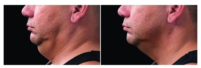CoolSculpting papada antes y después - hombre