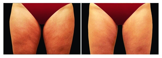 CoolSculpting antes y después - piernas