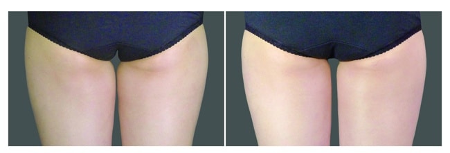 CoolSculpting piernas