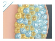 CoolSculpting tratamiento: crio-frío para destruir la grasa