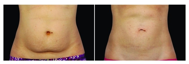 CoolSculpting antes y después - vientre