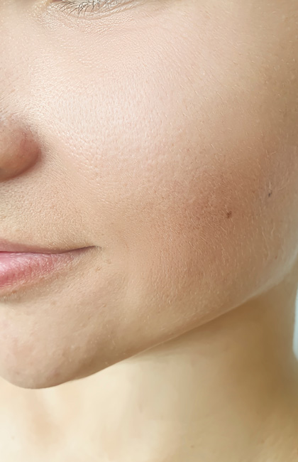 Estiramiento facial después