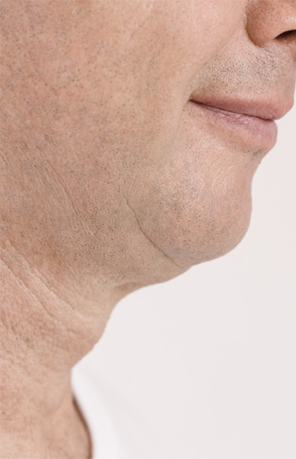 Lifting cuello antes