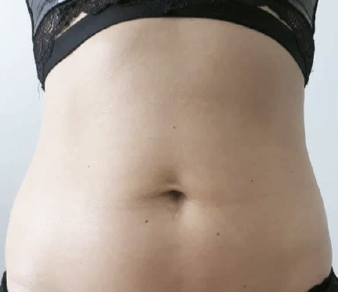 Indiba Deep Care antes