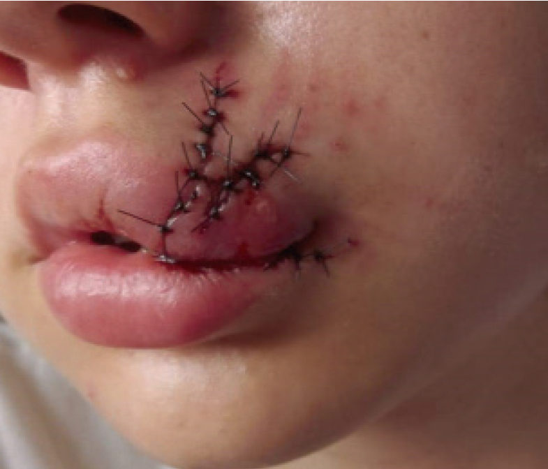 Indiba Deep Care cicatrices antes