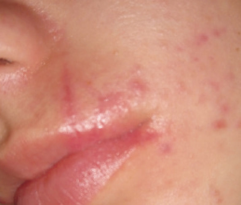 Indiba Deep Care cicatrices después