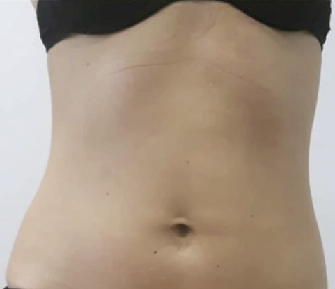 Indiba Deep Care después 