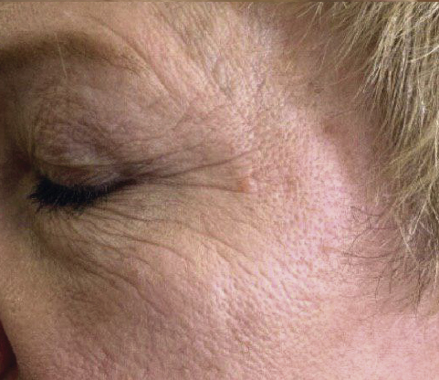 Indiba Deep Care párpados antes