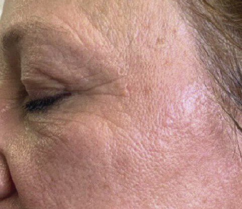 Indiba Deep Care párpados después