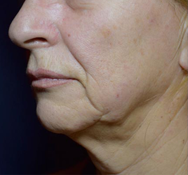 Lifting facial sin cirugía antes