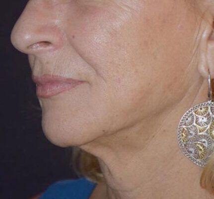 Lifting facial sin cirugía después