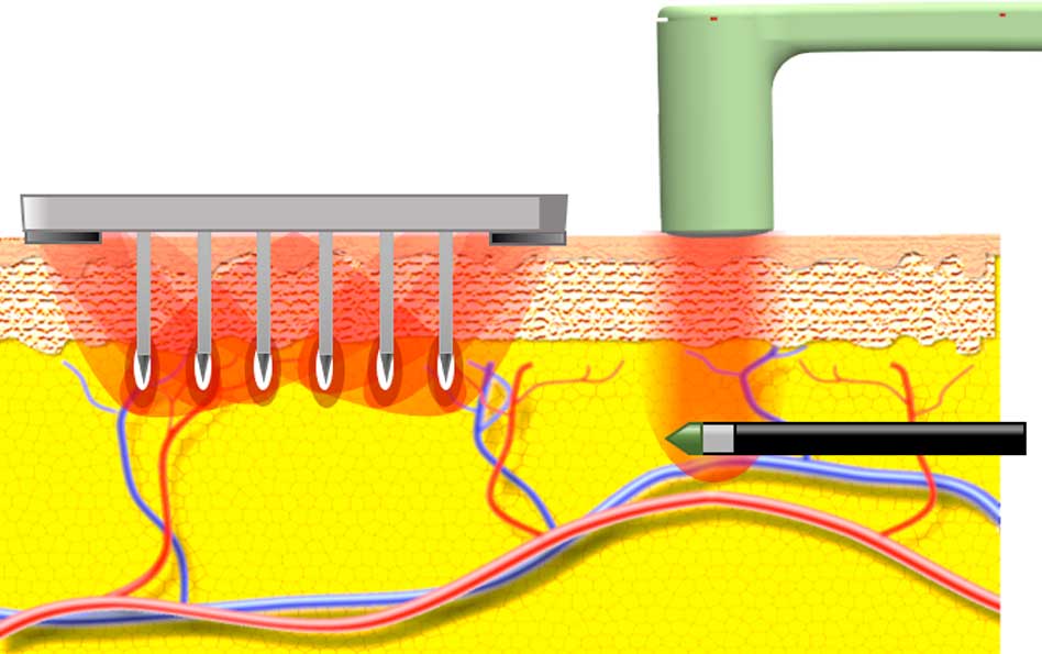 Tratamiento Morpheus