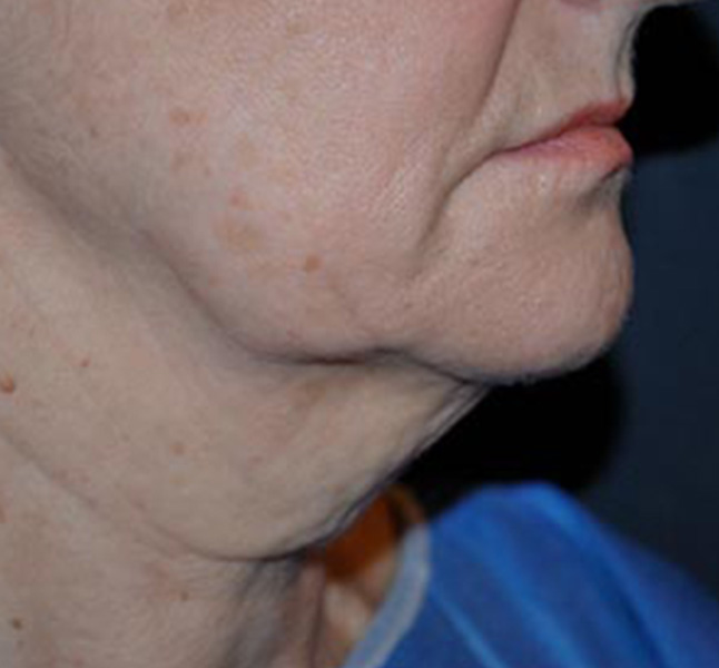 Rejuvenecimiento facial sin cirugía antes