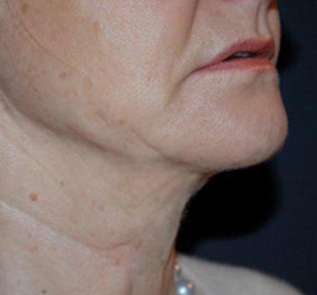 Rejuvenecimiento facial sin cirugía después