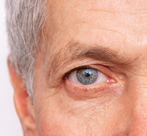 Blefaroplastia superior antes