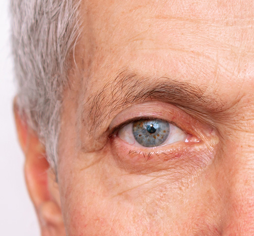 Blefaroplastia superior después