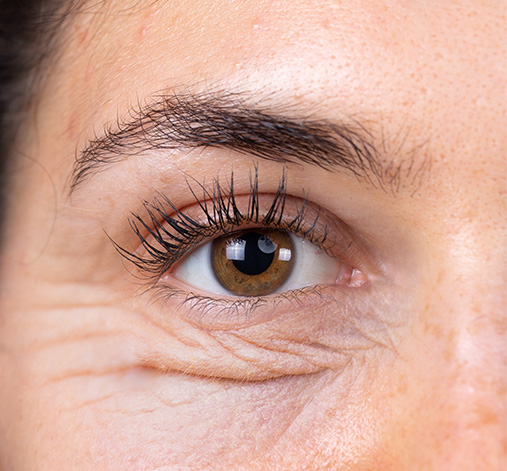 Blefaroplastia inferior antes