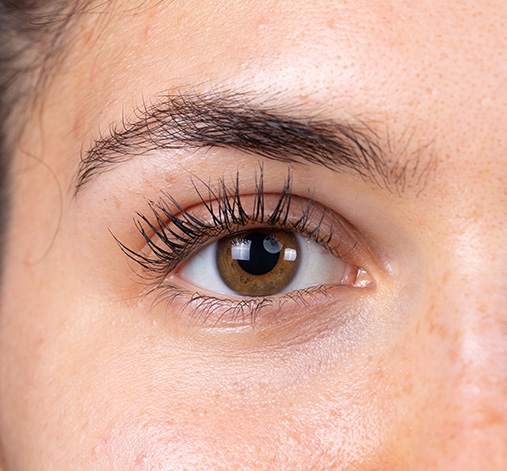 Blefaroplastia inferior después