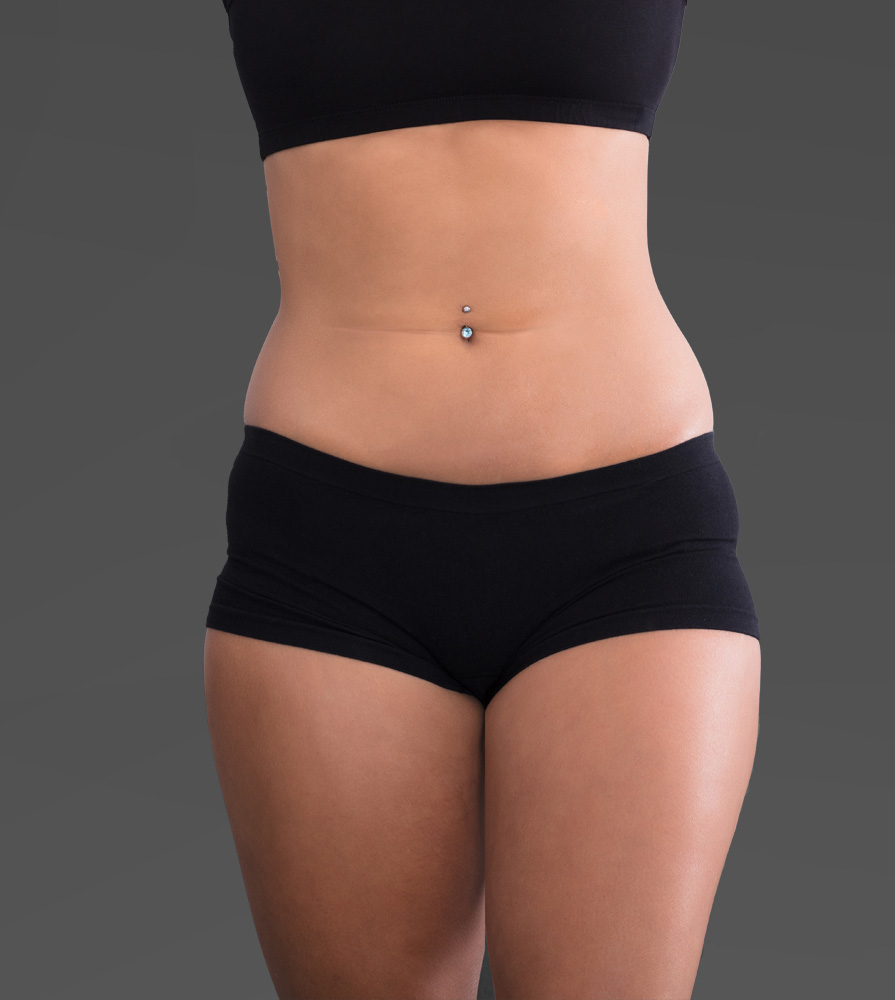 Mesoterapia corporal antes 