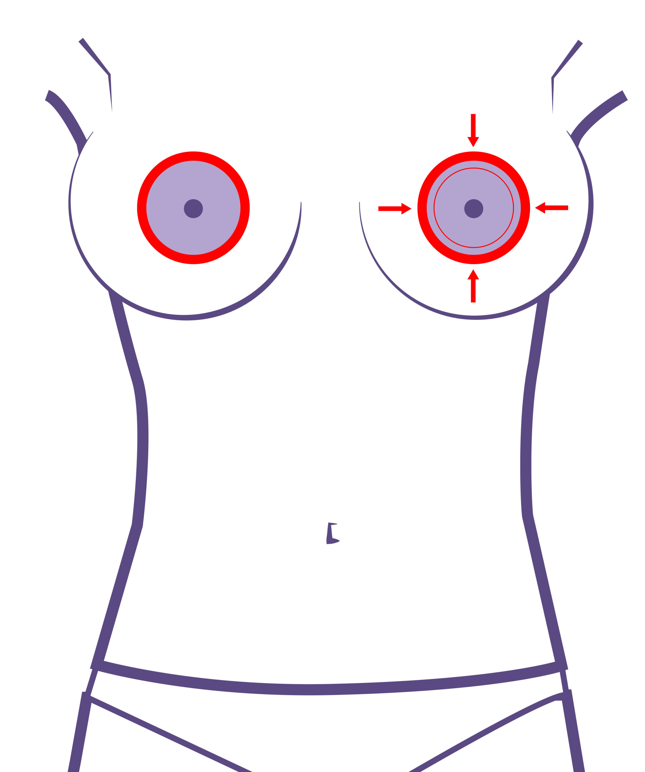 Antes y despues reducción de areolas /pezón