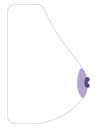 Inversión del pezón